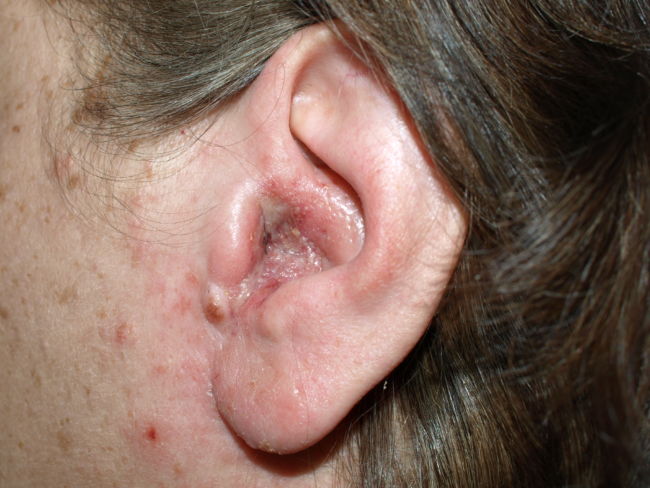 Penyakit di Bagian Telinga